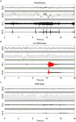 Sleep and Tibialis Anterior Muscle Activity in Mice With Mild Hypoxia and Iron Deficiency: Implications for the Restless Legs Syndrome